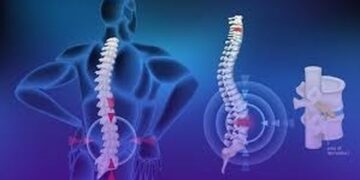 دیسک کمری؛ شایعترین علت کمردرد و سیاتیک در میانسالان