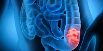 سن ابتلا به سرطان روده بزرگ در ایران کاهش یافت